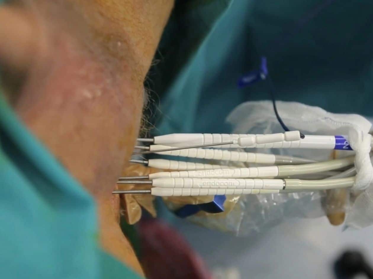 Máquina para realizar tratamiento de criocirugía de próstata aplicada en la clínica Dr. Pedro Torrecillas